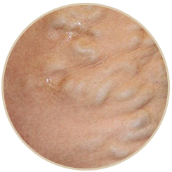 Vein Center Orland Park IL